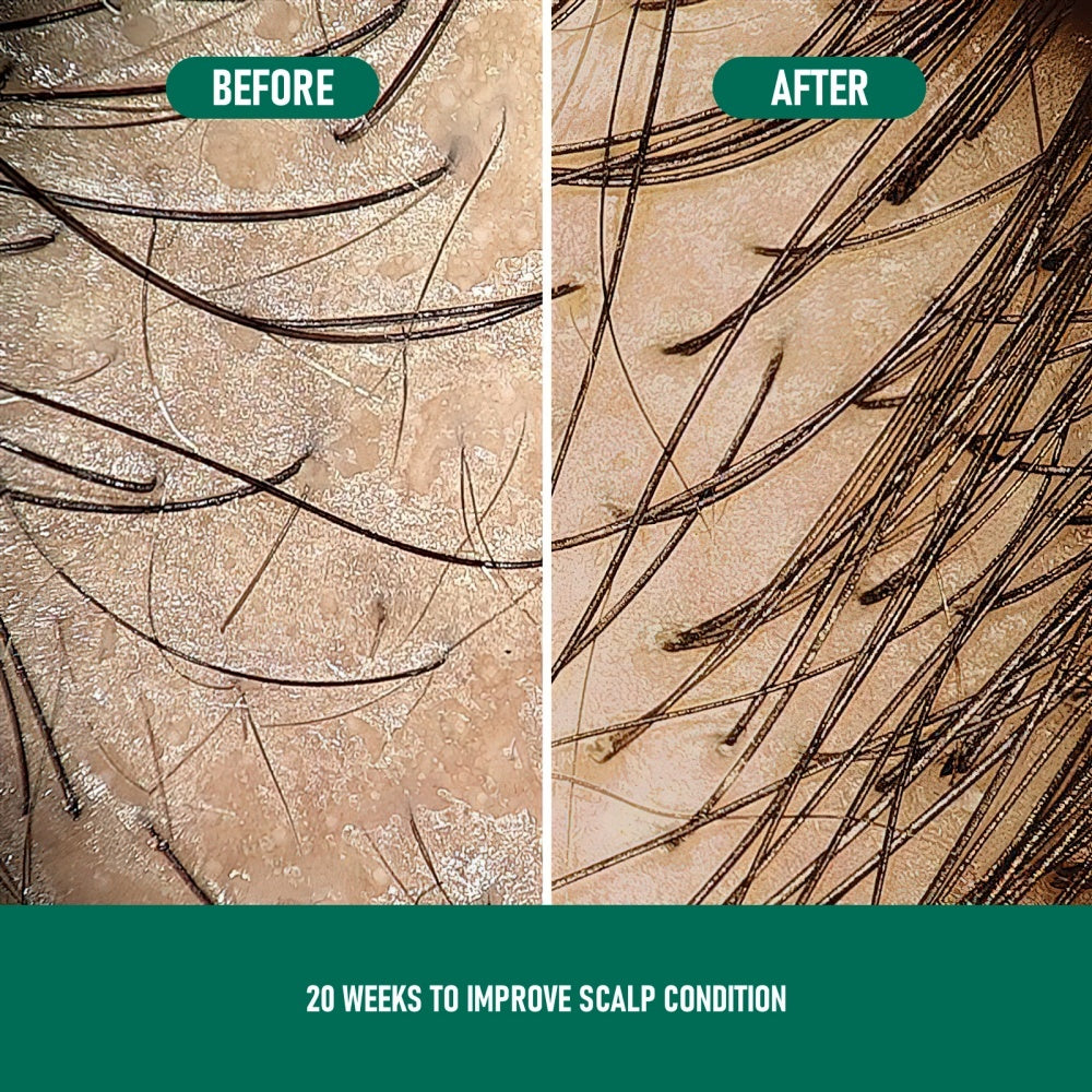 CHOO4 Minoxidil (Anti-Hair Loss)