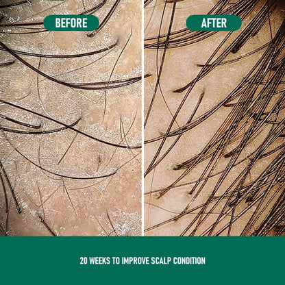 CHOO4 Minoxidil (Anti-Hair Loss)