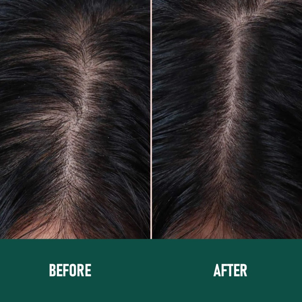 CHOO4 Minoxidil (Anti-Hair Loss)
