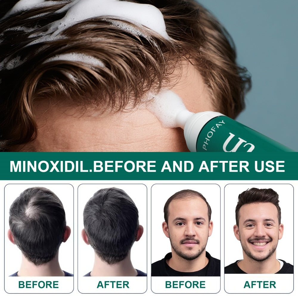 CHOO4 Minoxidil (Anti-Hair Loss)
