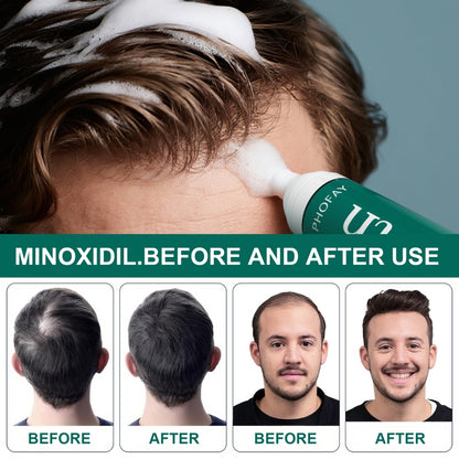 CHOO4 Minoxidil (Anti-Hair Loss)